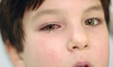 Аллергический конъюнктивит у детей
