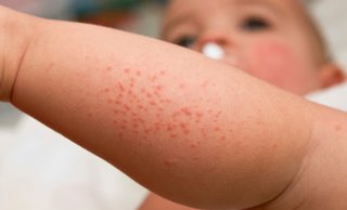 Лечение дерматитов у детей
